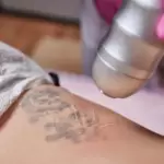 aparatologia estetica en alicante (8)