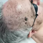 eliminacion imperfecciones con laser azul (9)